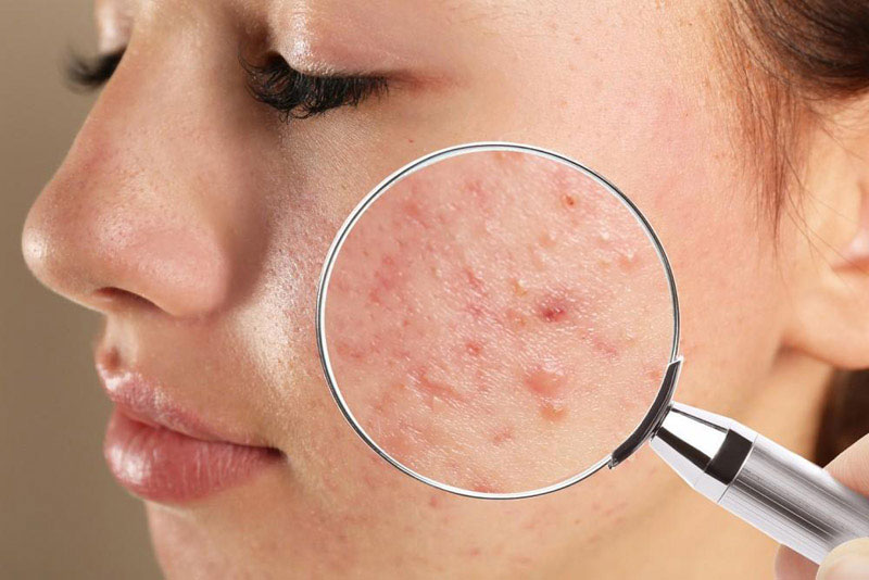 3 Common Types of Acne and How to Treat Them: Rapaport Dermatology of Beverly Hills: Dermatologists